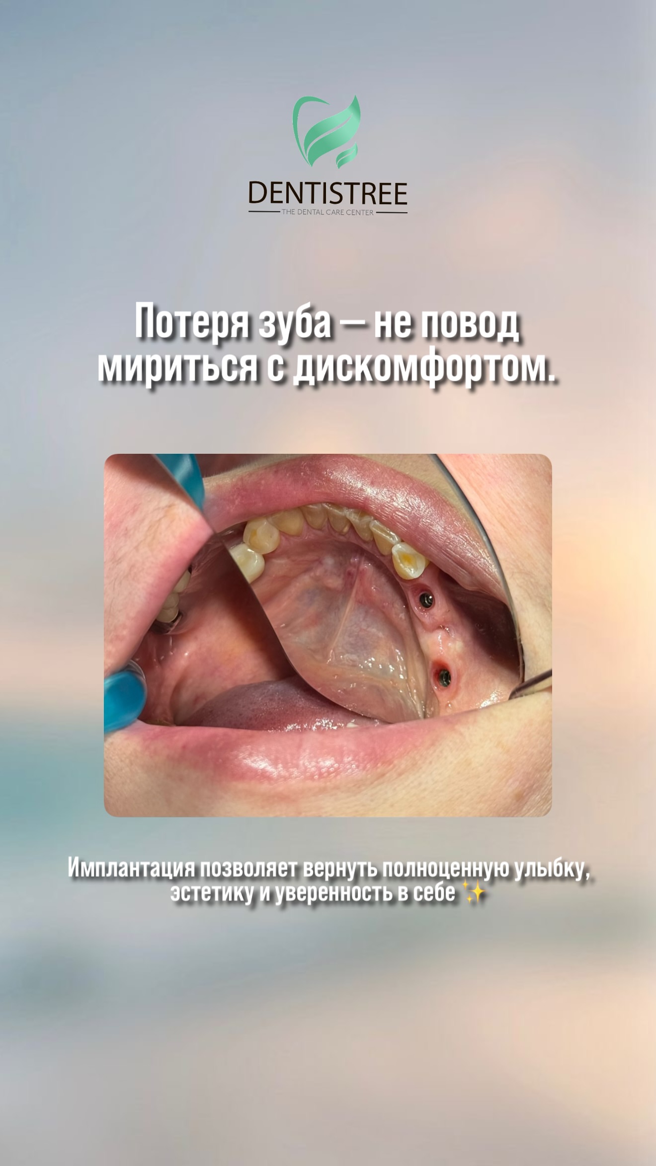 Имплантация зубов