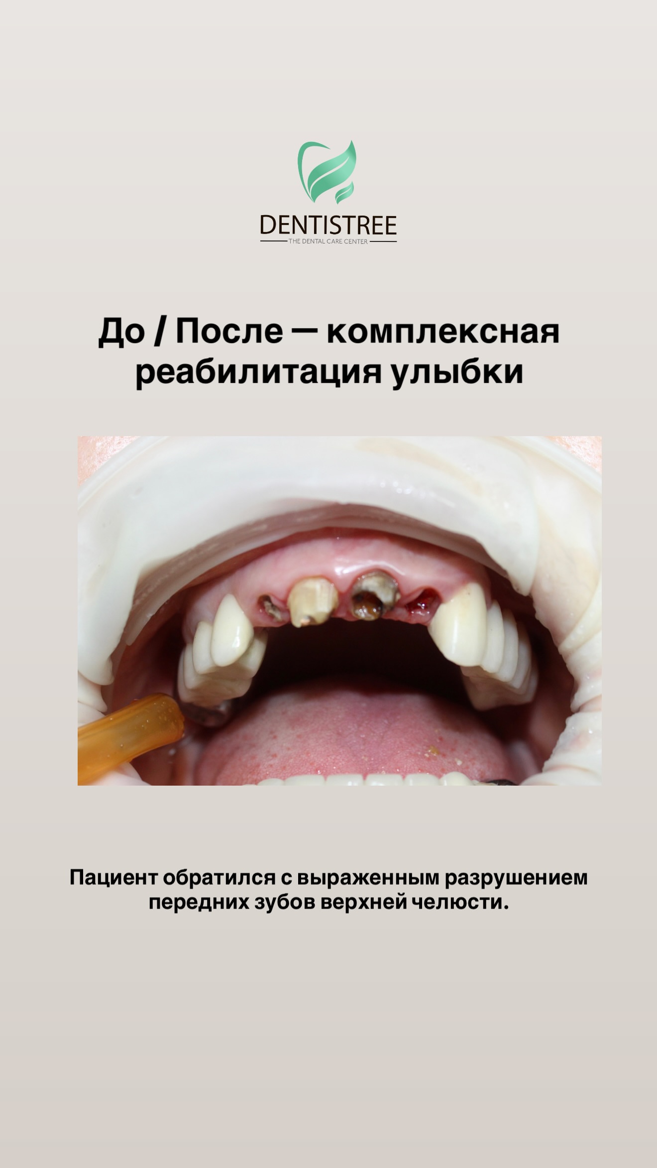 Синус-лифтинг